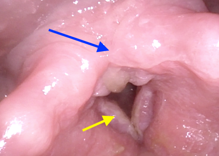 Chronische Laryngitis