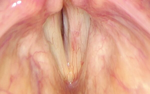 Sulcus vocalis